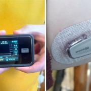An insulin pump, left, and CGM sensor in the arm, create a closed loop system for diabetes